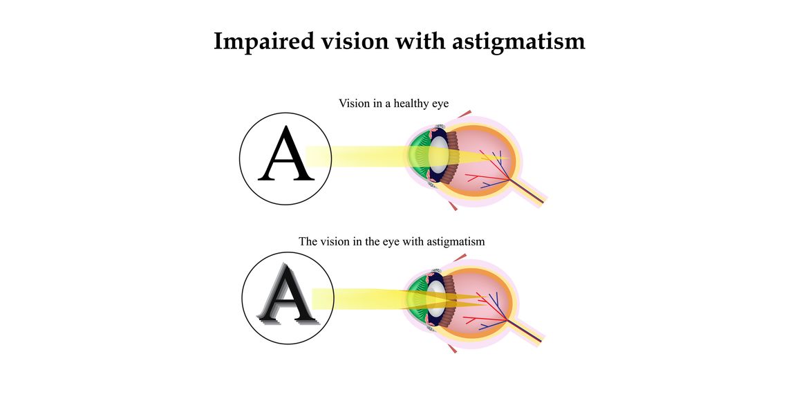 Astigmatism